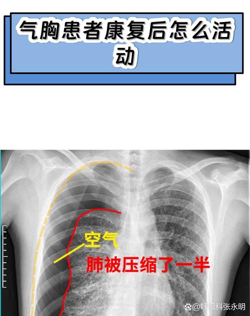 因气胸缺席至今！活塞官方：坎宁安正在康复将在一周后接受复查